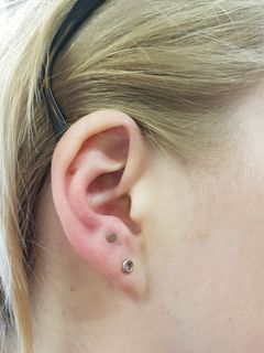 16 gauge anti-tragus