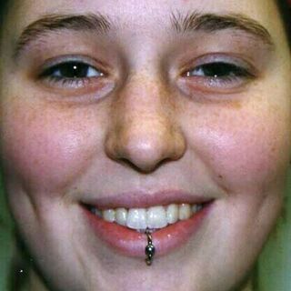 Healed Labret Piercing
