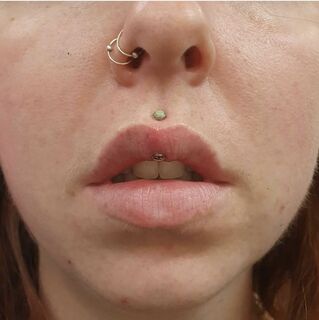 14gauge vertical philtrum