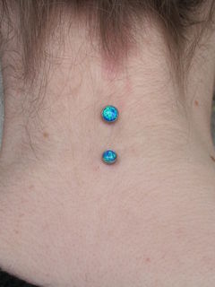 14gauge nape anchor