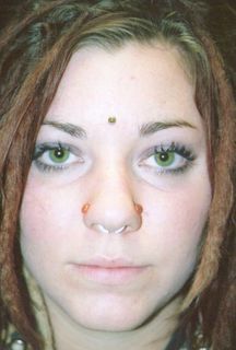 14gauge forehead anchor